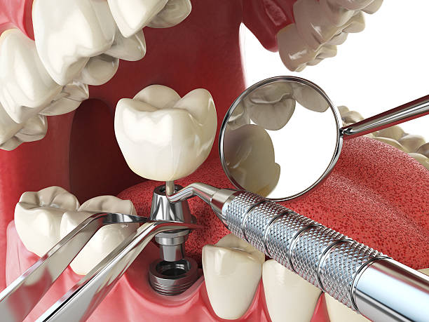 Best Emergency Dental Care for Broken or Chipped Teeth in Waynesburg, OH